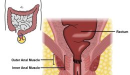 anal cancer