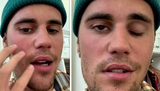 Justin Bieber's paralyzed face