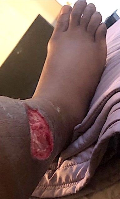 Dog bit off chunk of leg